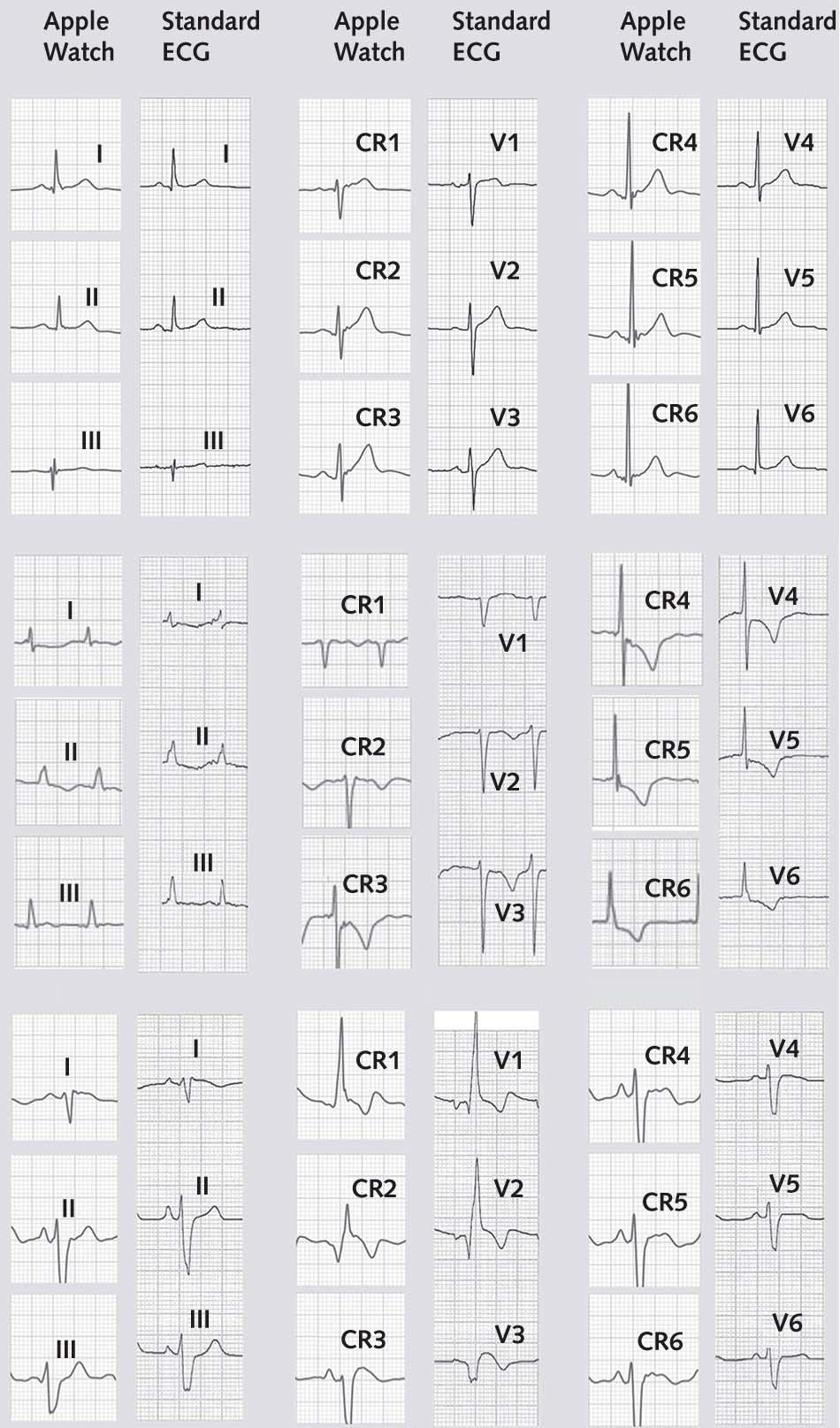 Electrocardiogramas Apple Watch vs electrocardiógrafo